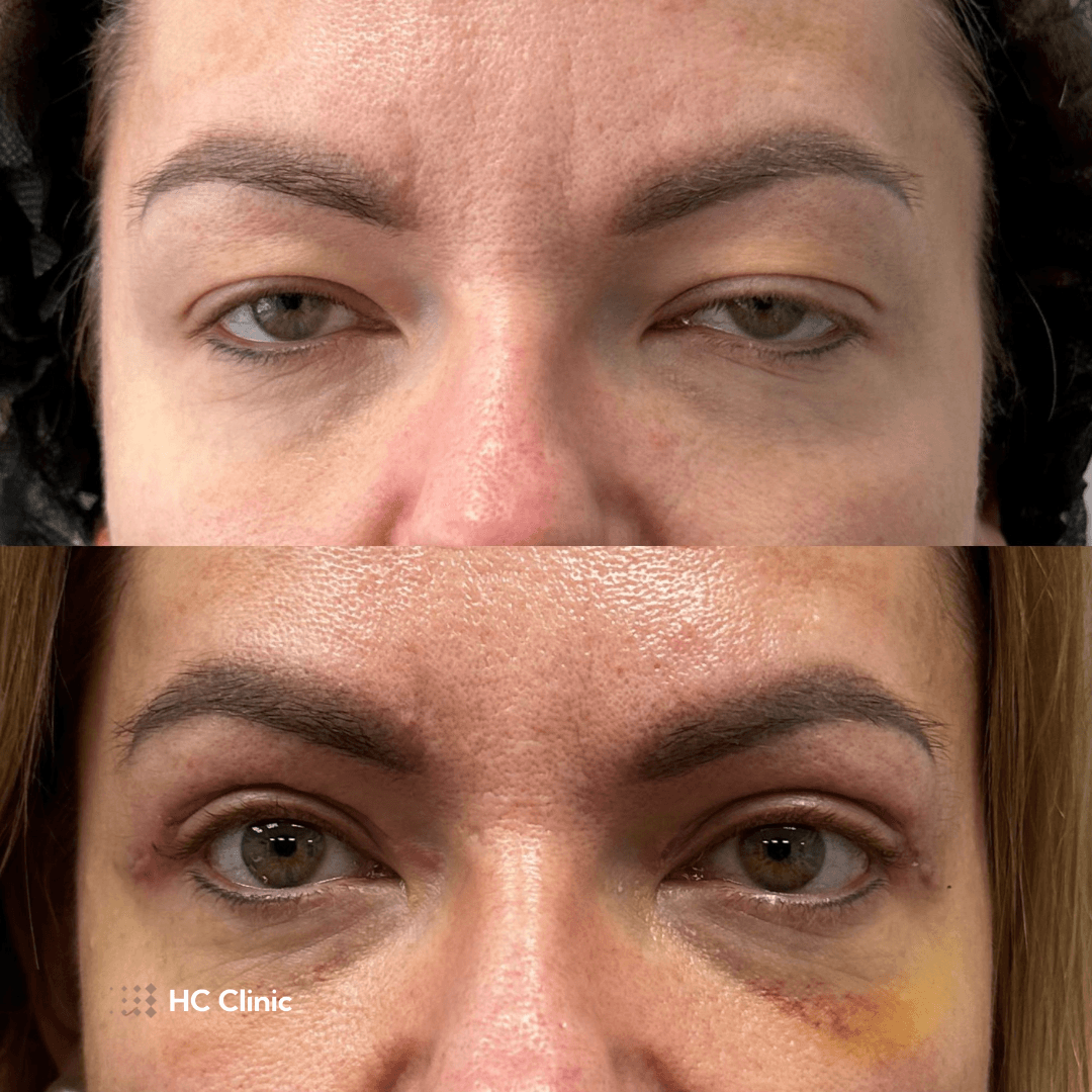 Blefaroplastyka HCClinic efekt7
