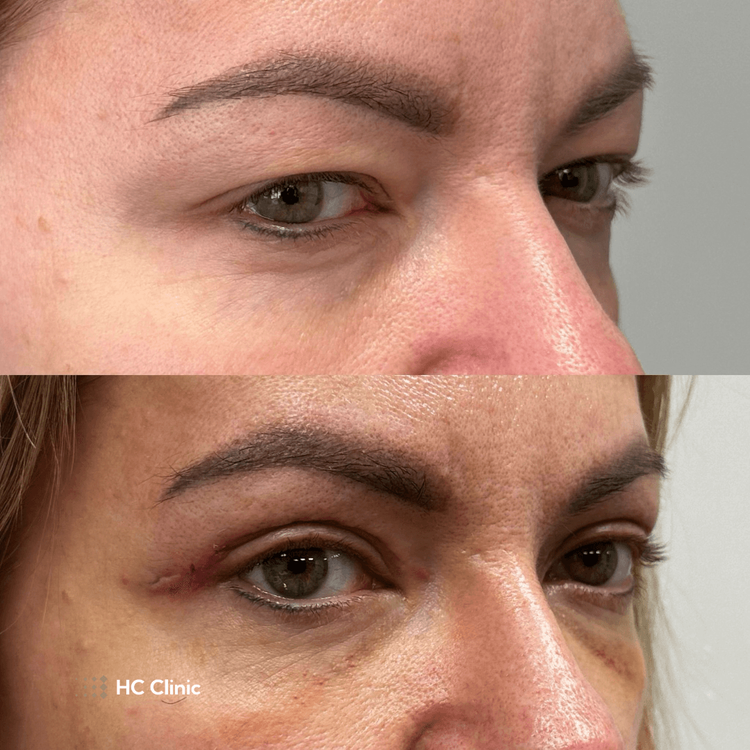 Blefaroplastyka HCClinic efekt8