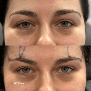 Browlift NICI COG HCClinic efekt1