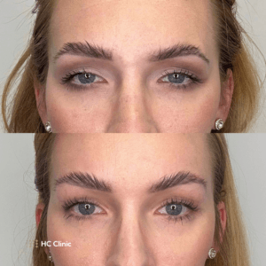 Browlift HCClinic efekt1