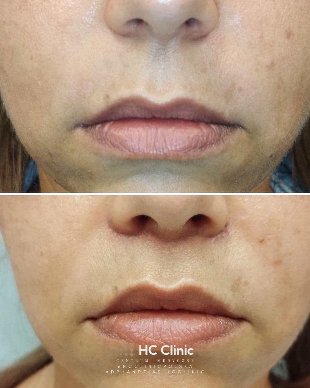 Lip lift - Chirurgiczny lifting wargi górnej 10 IMG 2338