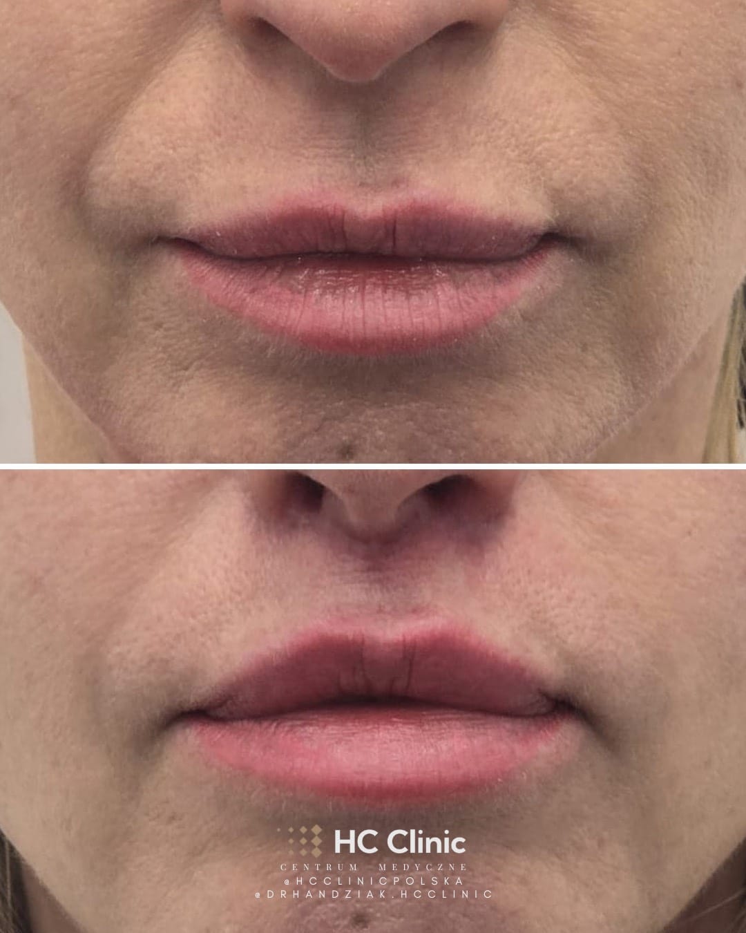 Lip lift - Chirurgiczny lifting wargi górnej 11 IMG 2339
