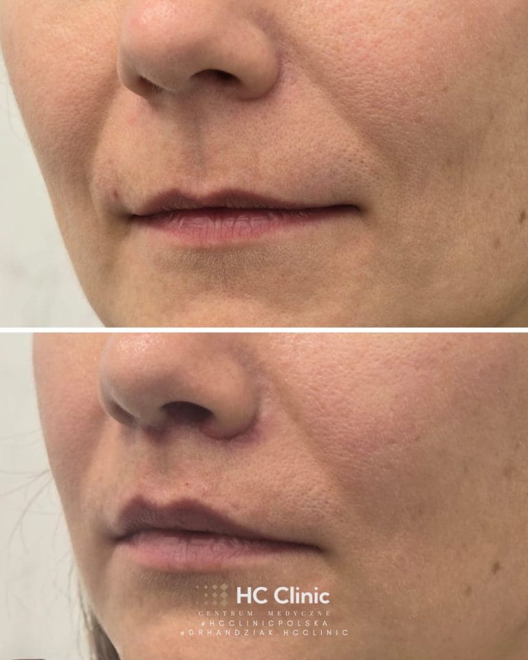 Lip lift - Chirurgiczny lifting wargi górnej 2 IMG 2343