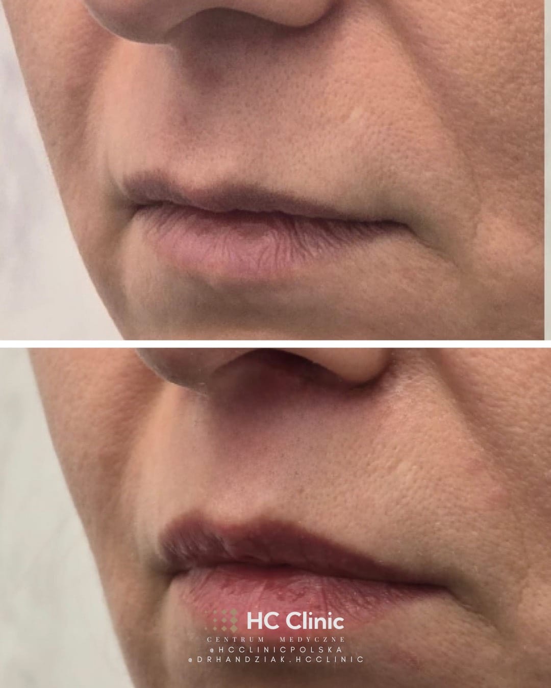 Lip lift - Chirurgiczny lifting wargi górnej 4 IMG 2344 1