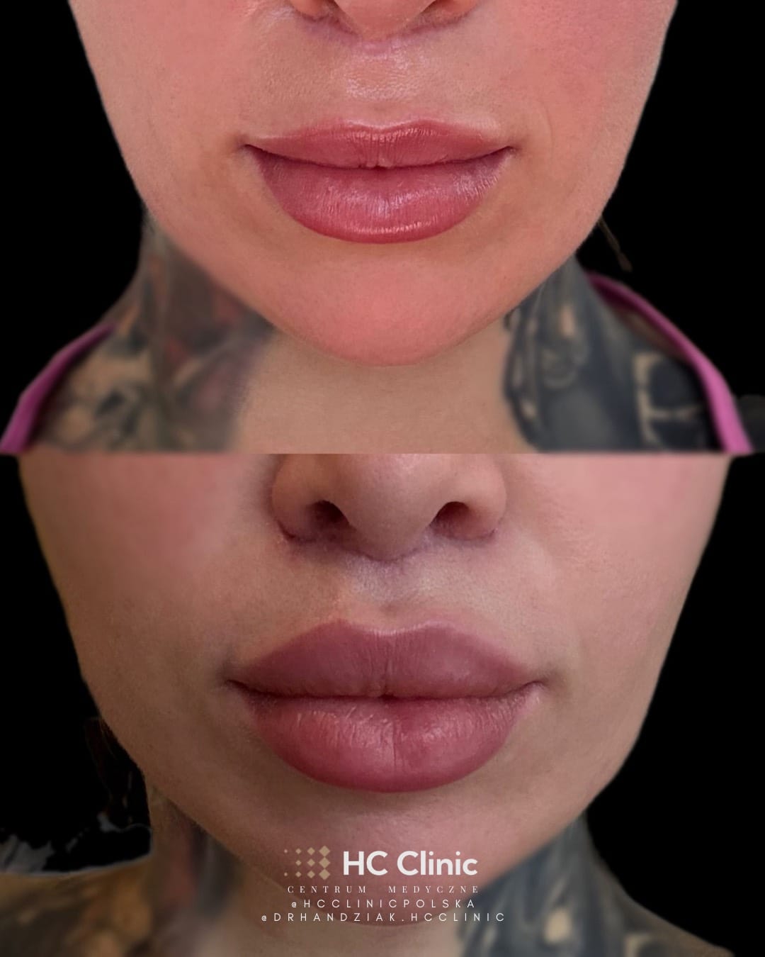 Lip lift - Chirurgiczny lifting wargi górnej 5 Instagram new 2025 1