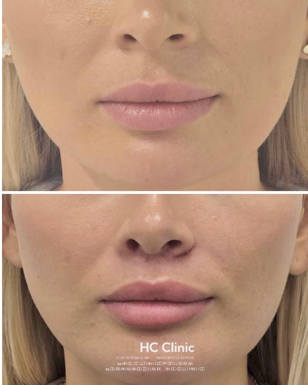 Lip lift - Chirurgiczny lifting wargi górnej 6 Instagram new 2025.zip 1