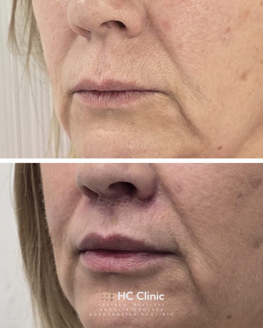 Lip lift - Chirurgiczny lifting wargi górnej 9 Instagram new 2025.zip 7
