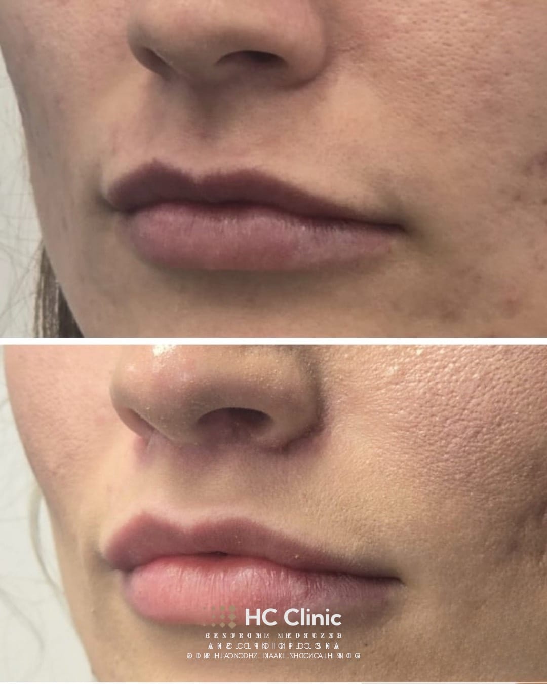 Lip lift - Chirurgiczny lifting wargi górnej 7 Instagram new 2025 1