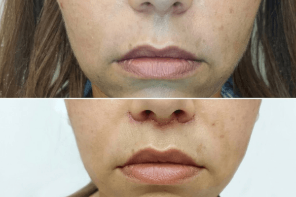 LipLift – efekty przed i po