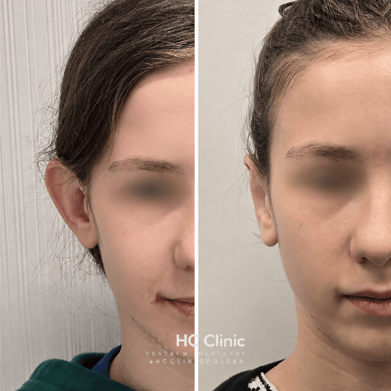 Efekty zabiegów chirurgia plastyczna 3 ChatGPT Image 24 sie 2026 15 35 25