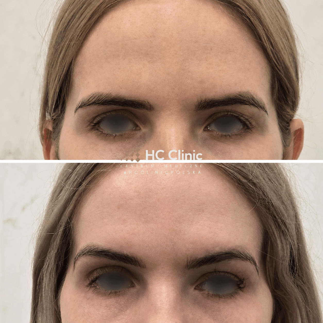 Browlift - chirurgiczne podniesienie brwi i czoła 1 ChatGPT Image 25 sie 2026 13 53 09